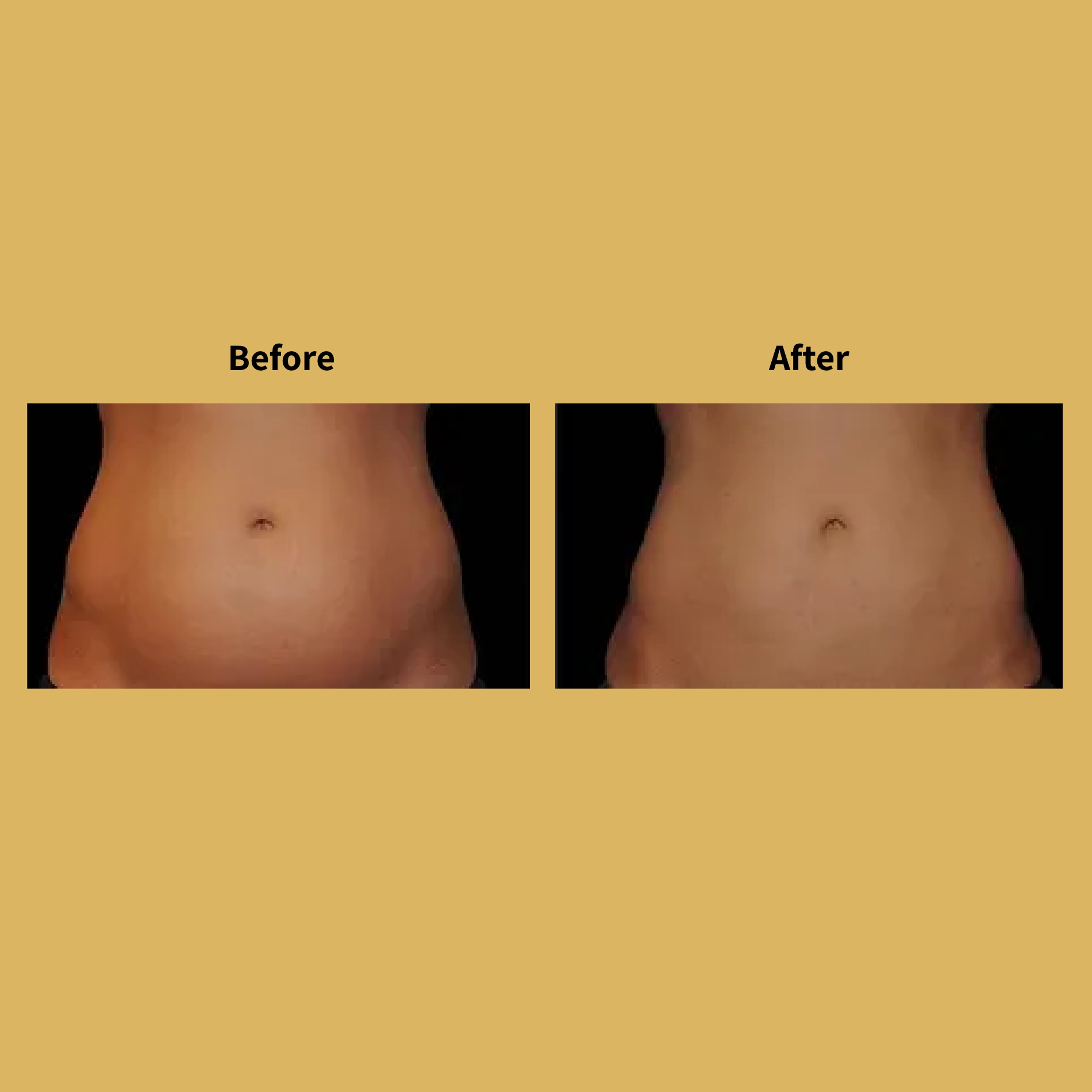 Body-Contouring-before-and-after-Images-Soleil-a