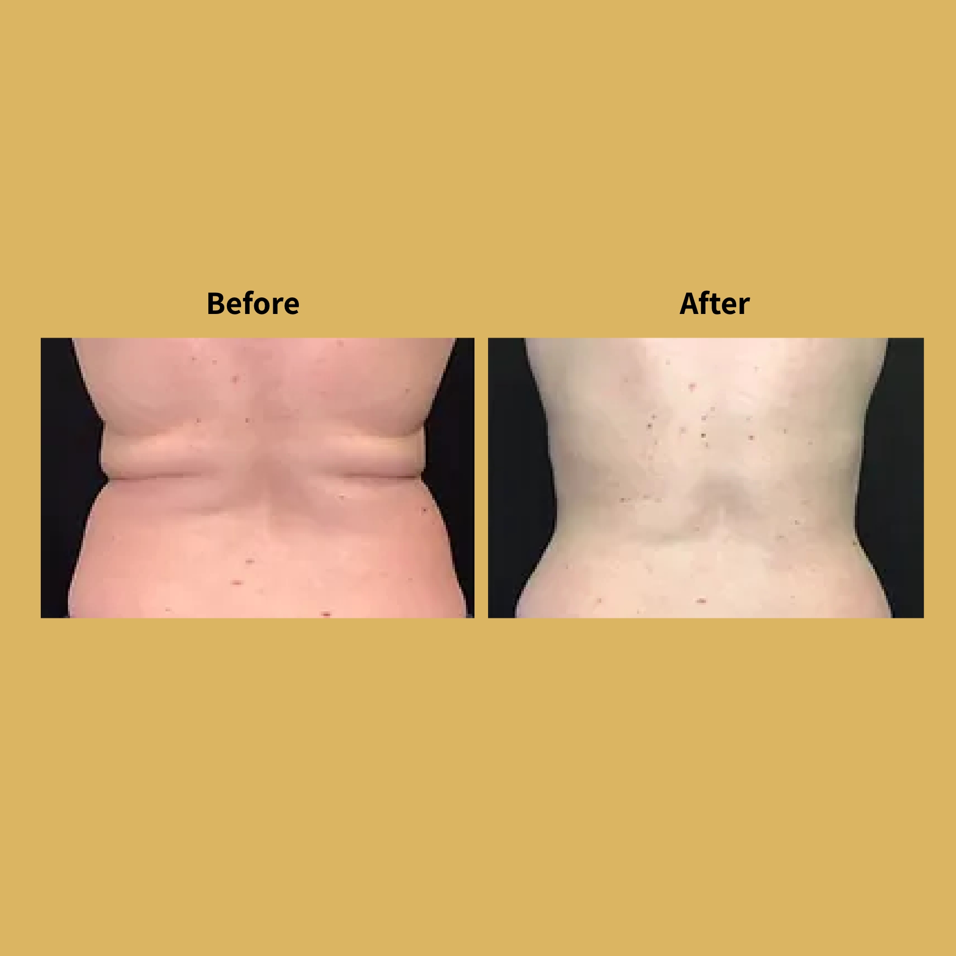 Body-Contouring-before-and-after-Images-Soleil-b