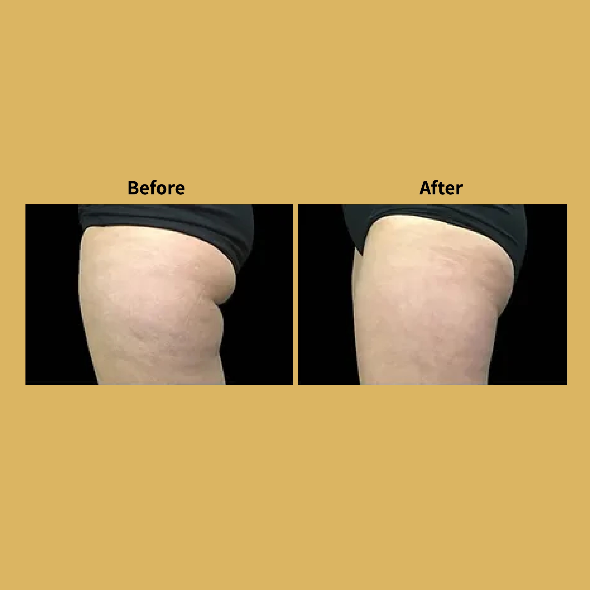Body-Contouring-before-and-after-Images-Soleil-f