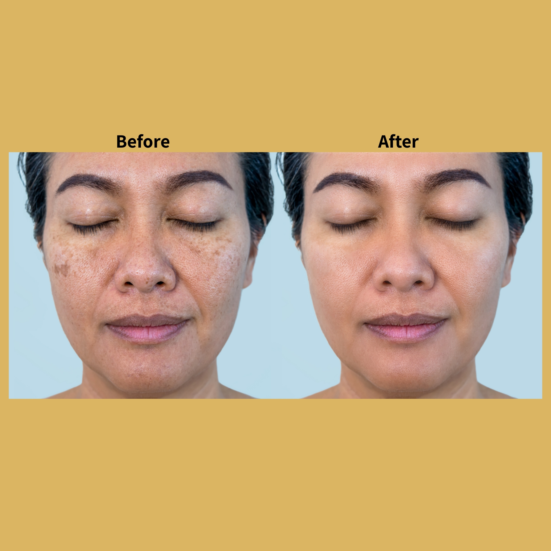 Co2 Fractional Laser Treatment Before and After Photos | Soleil Medical & Beauty Spa in Portland, OR