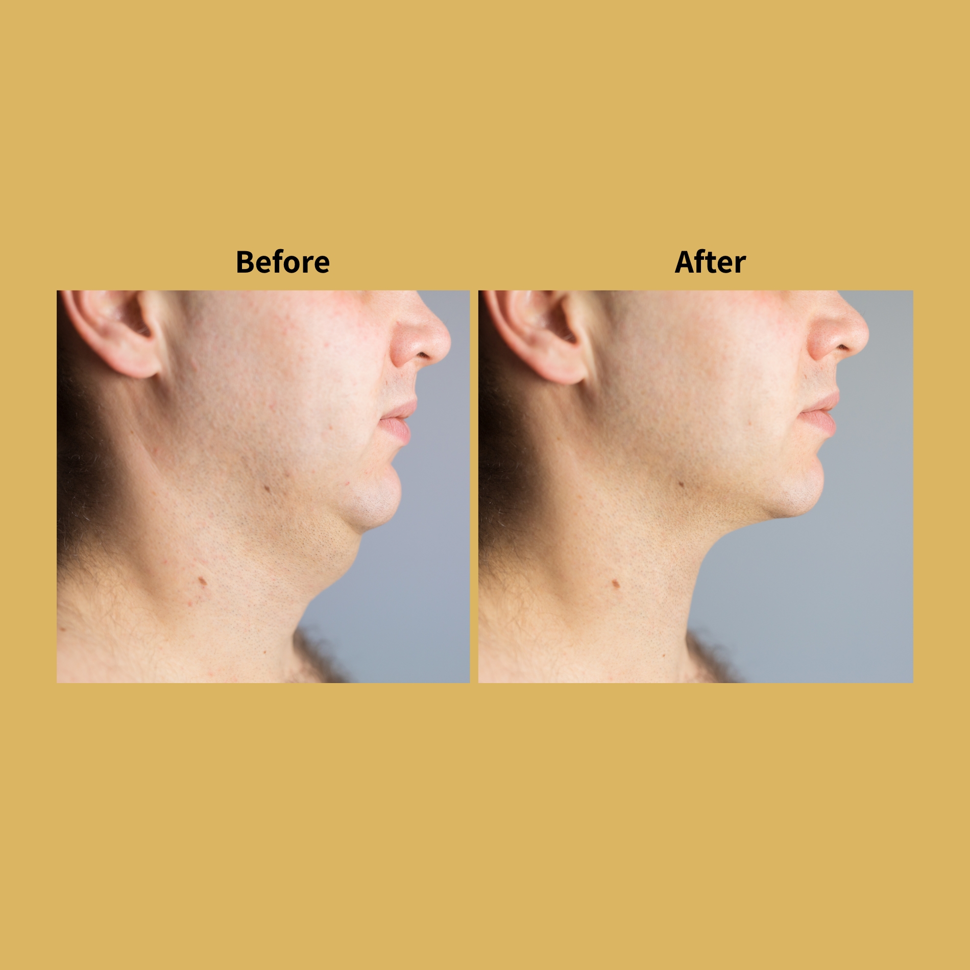 Kybella Double Chin Removal Before and After Photos | Soleil Medical & Beauty Spa in Portland, OR