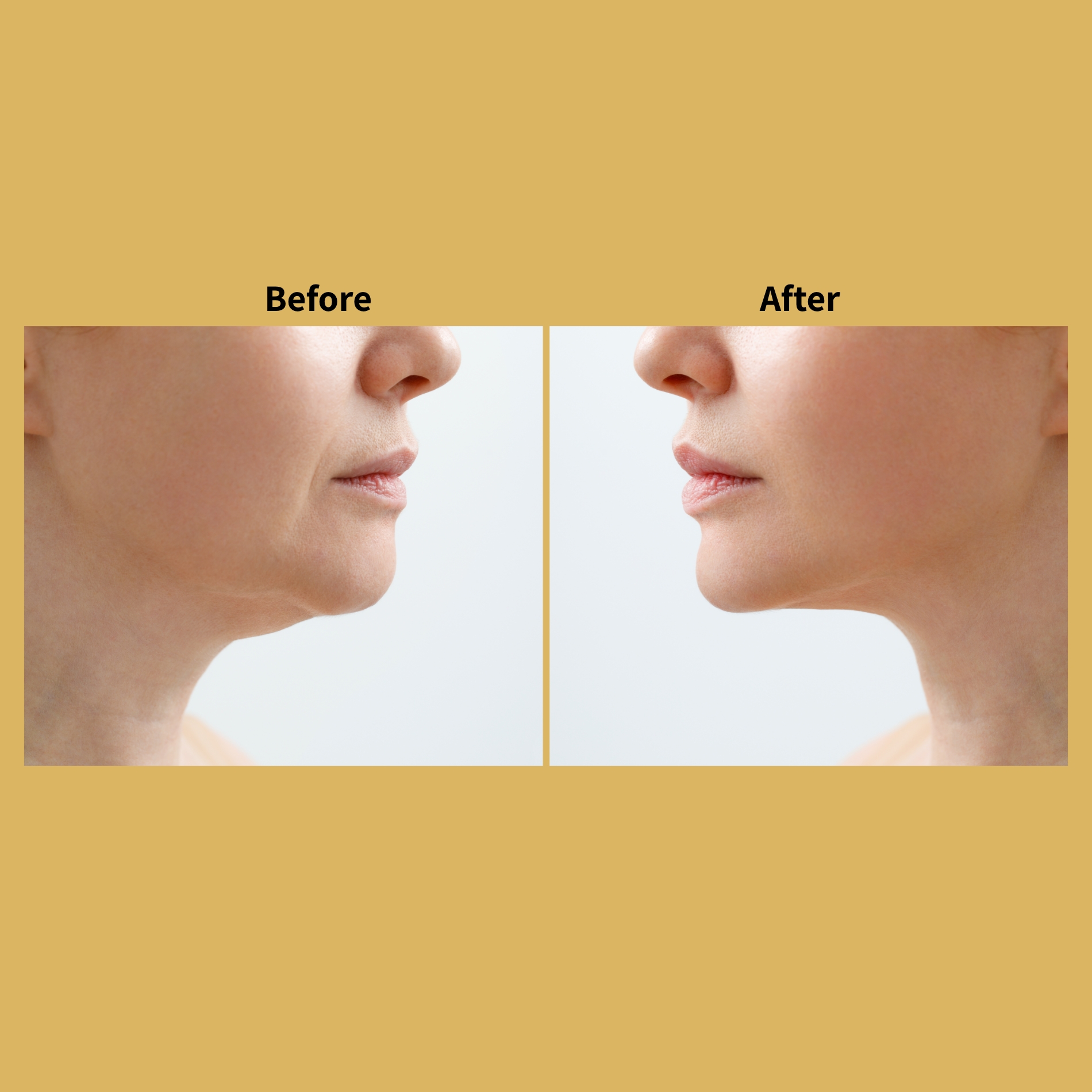 Kybella Double Chin Removal Before and After Photos | Soleil Medical & Beauty Spa in Portland, OR