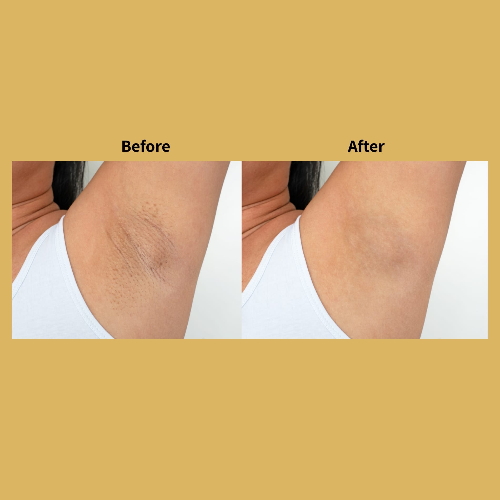 Laser Rejuvenation Before and After Underarms | Soleil Medical & Beauty Spa in Portland, OR