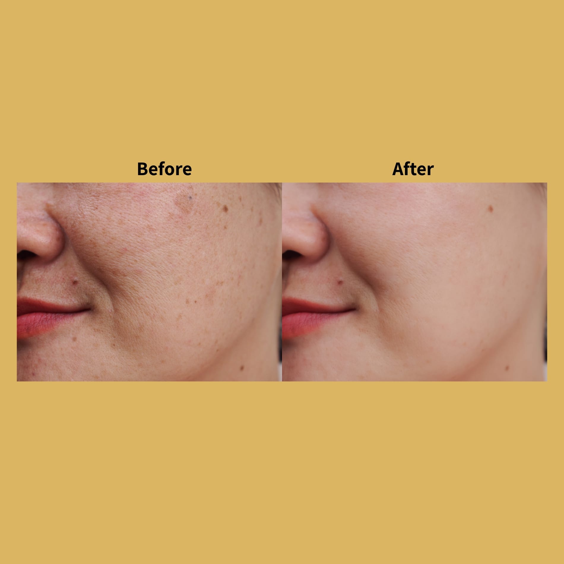 Laser Rejuvenation Before and After Photos | Soleil Medical & Beauty Spa in Portland, OR