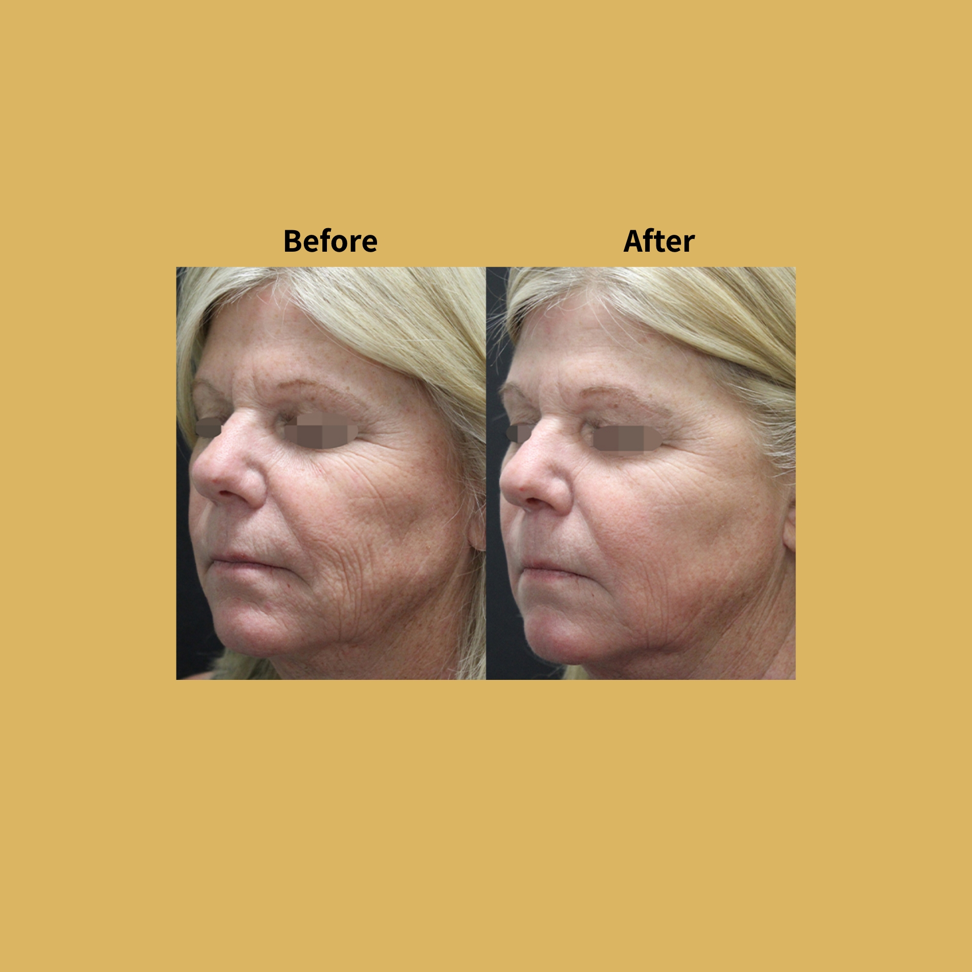 Opus Plasma Before and After Treatment Photos | Soleil Medical & Beauty Spa in Portland, OR