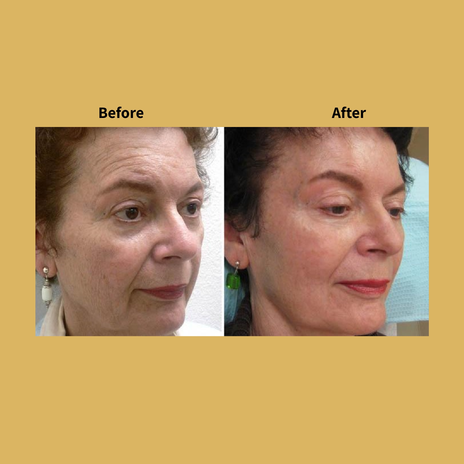 Pixel Perfect Laser Treatment Before and After Photos | Soleil Medical & Beauty Spa in Portland, OR