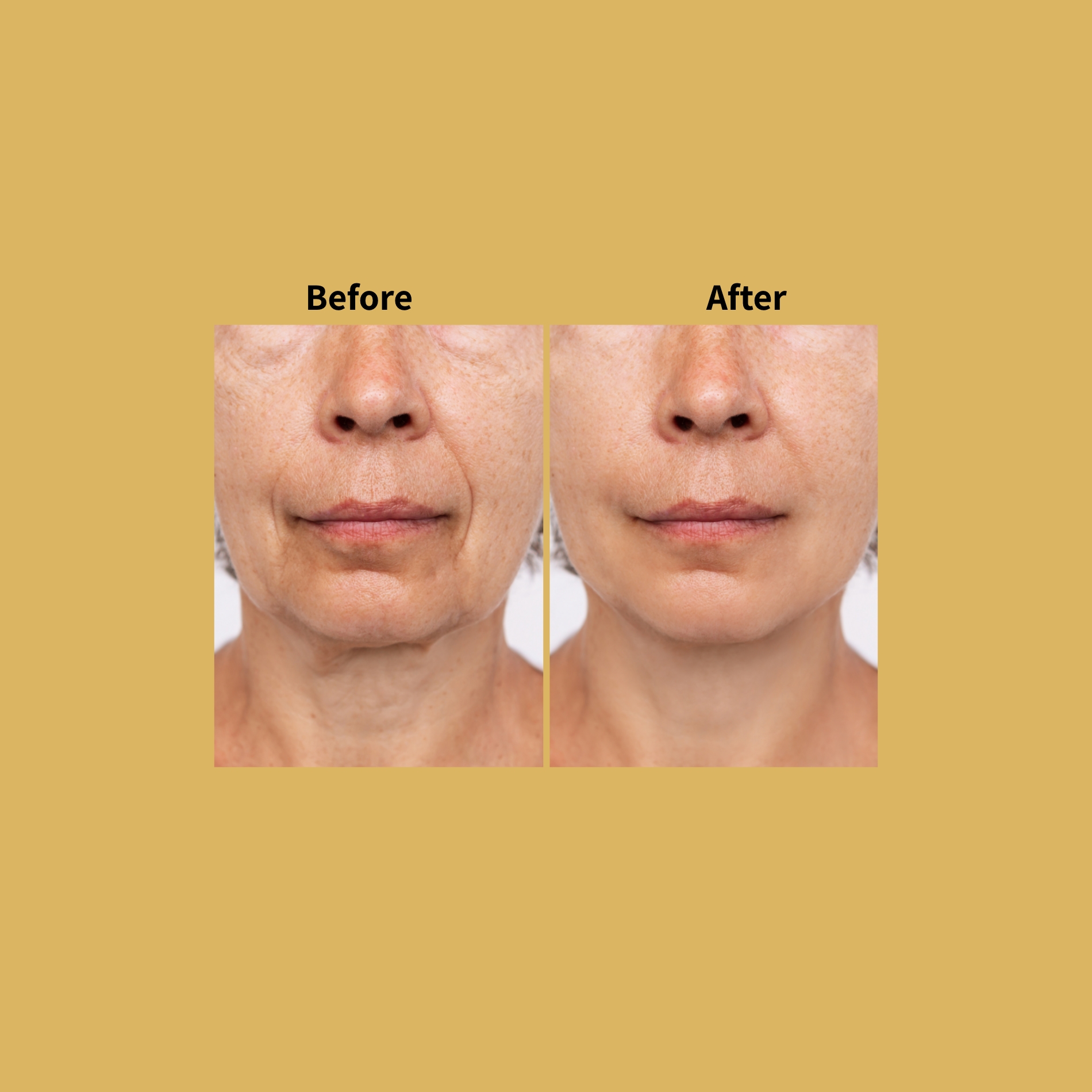 Secret RF Fractional Microneedling Before and After Photos | Soleil Medical & Beauty Spa in Portland, OR