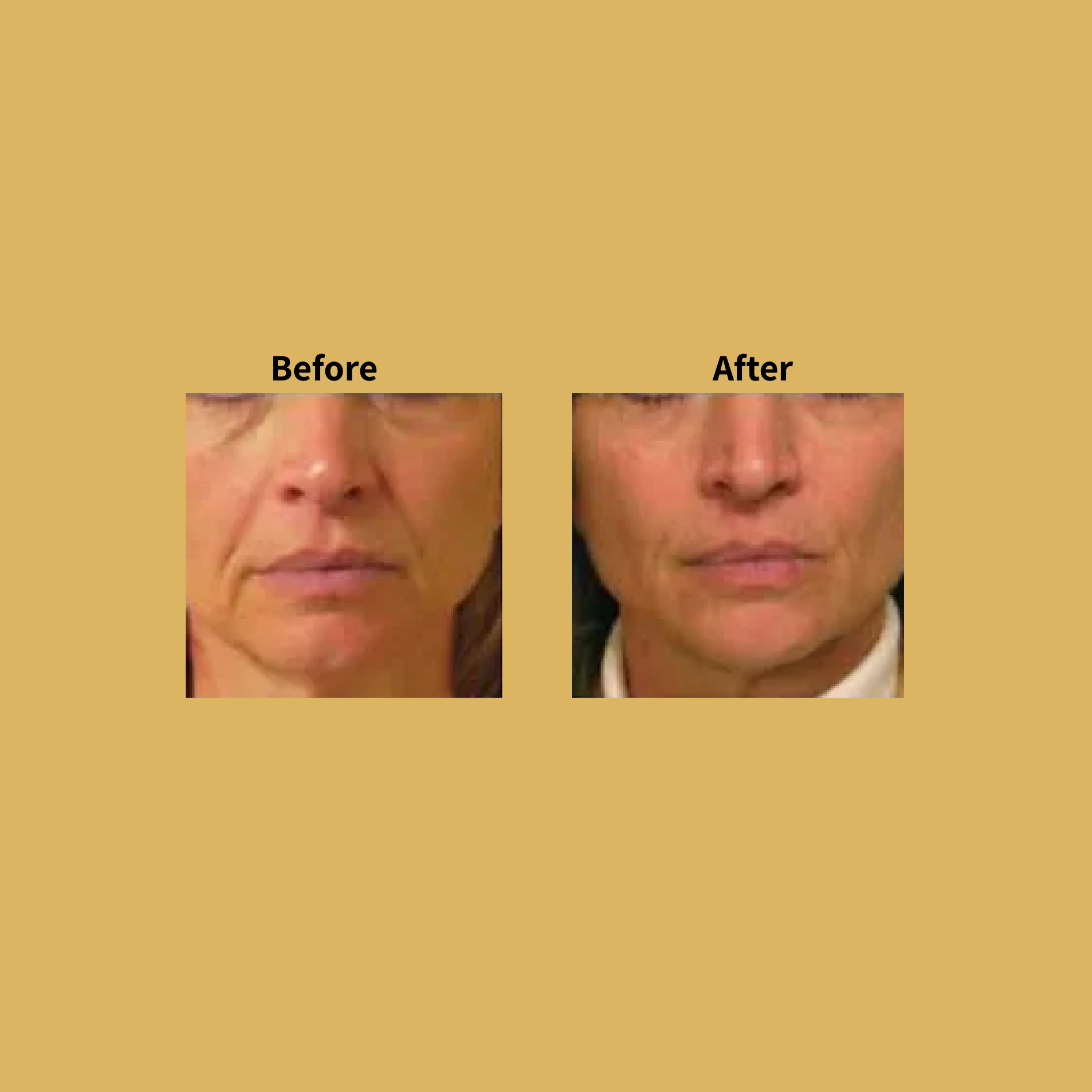 Titan Non-Surgical Facelift Before and After Treatment Photos | Soleil Medical & Beauty Spa in Portland, OR