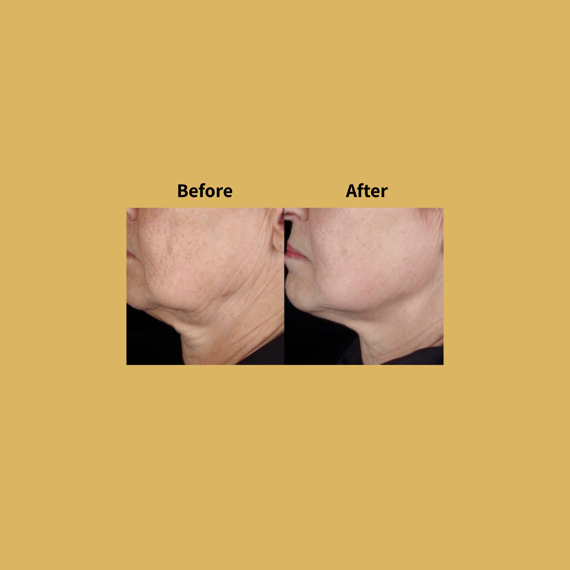 Titan Non-Surgical Facelift Treatment Before and After Photos | Soleil Medical & Beauty Spa in Portland, OR