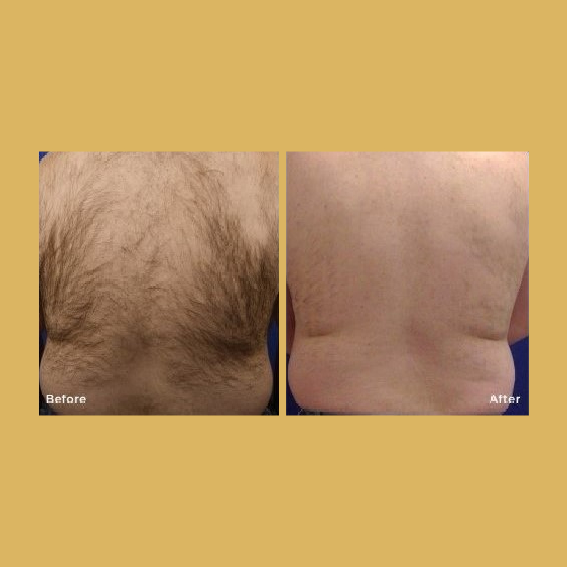 Male Laser Hair Removal Before and After Photos | Soleil Medical & Beauty Spa in Portland, OR