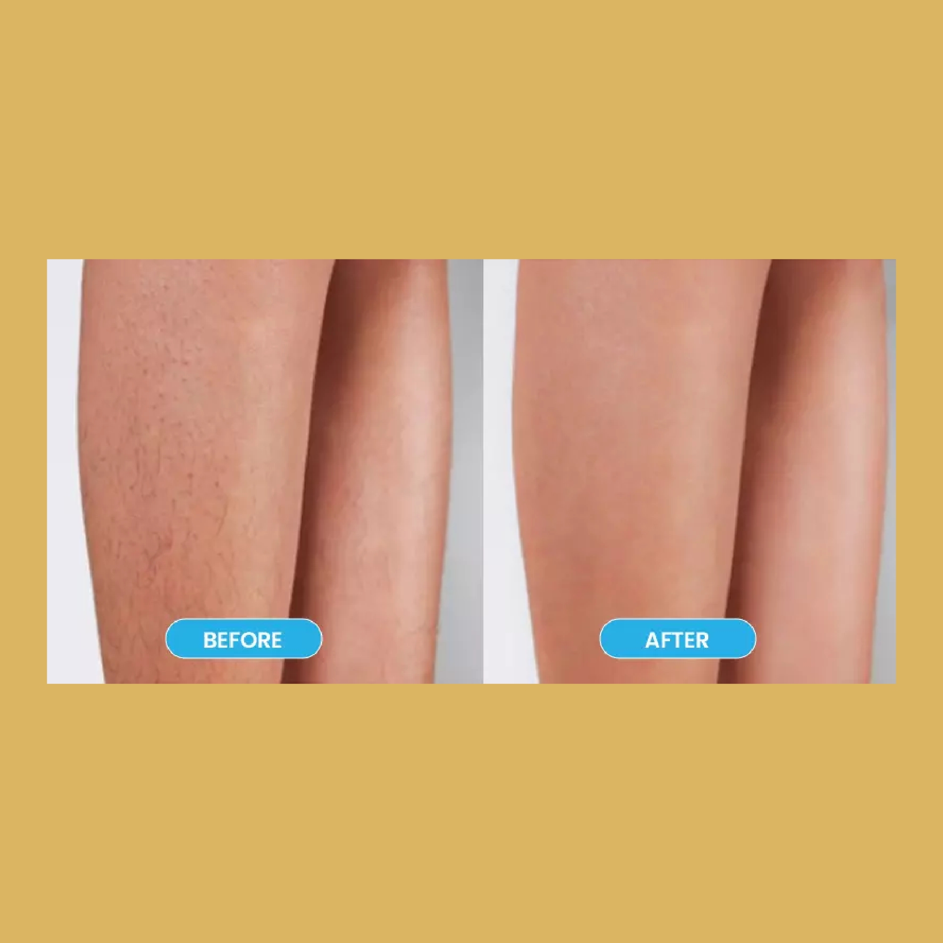 Laser Hair Removal Before and After Photos | Soleil Medical & Beauty Spa in Portland, OR