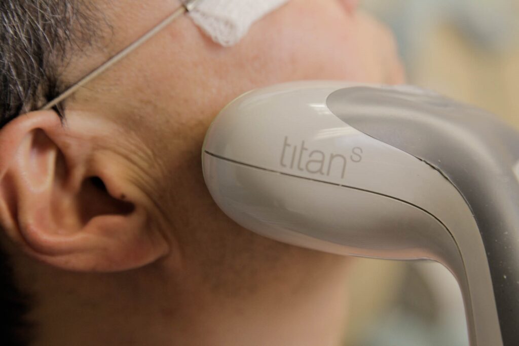 A man getting treatment by Titan device | Titan Non-Surgical Facelift by Cutera In Portland, OR| Soleil Medical & Beauty Spa