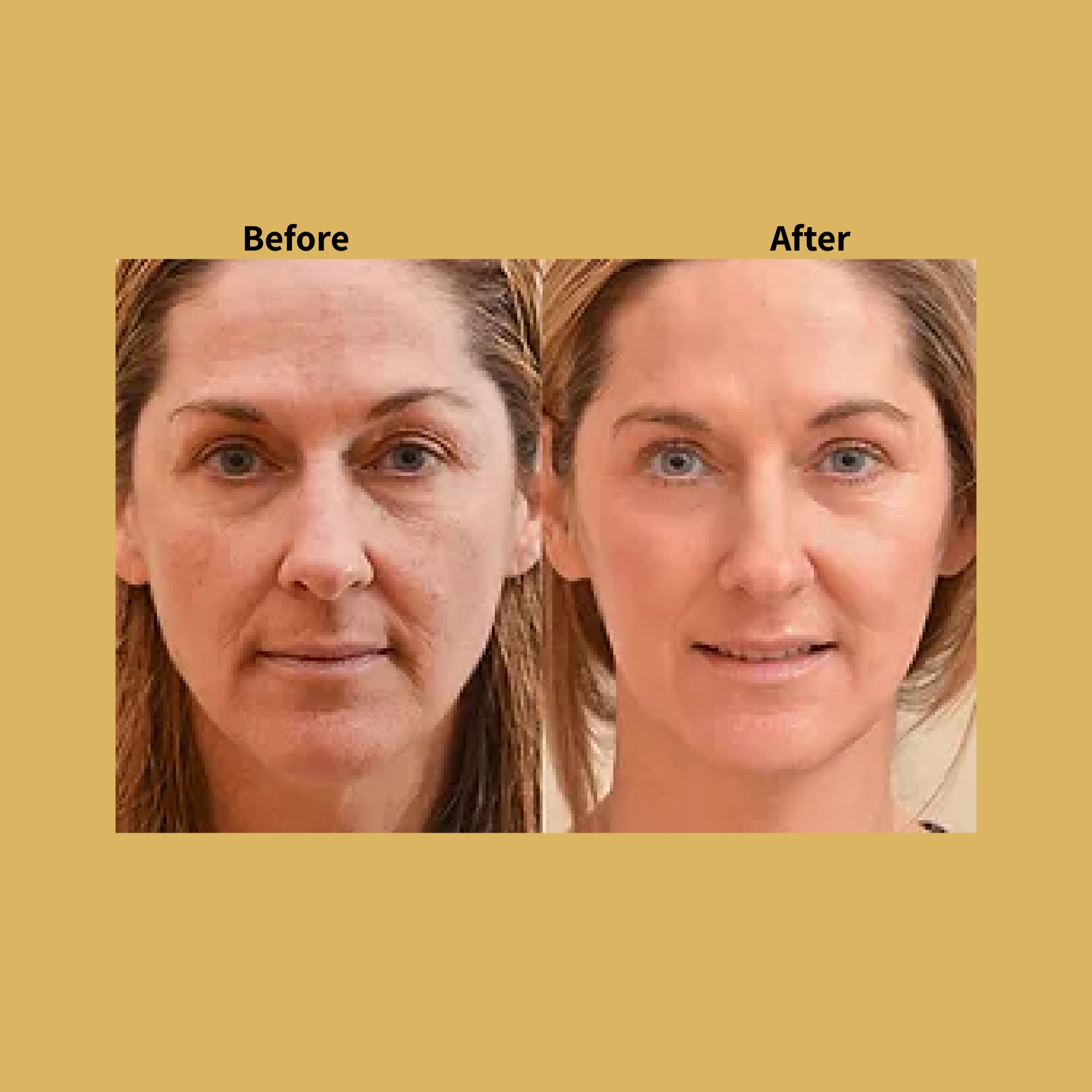 Co2 Fractional Laser Before and After Treatment Photos | Soleil Medical & Beauty Spa in Portland, OR