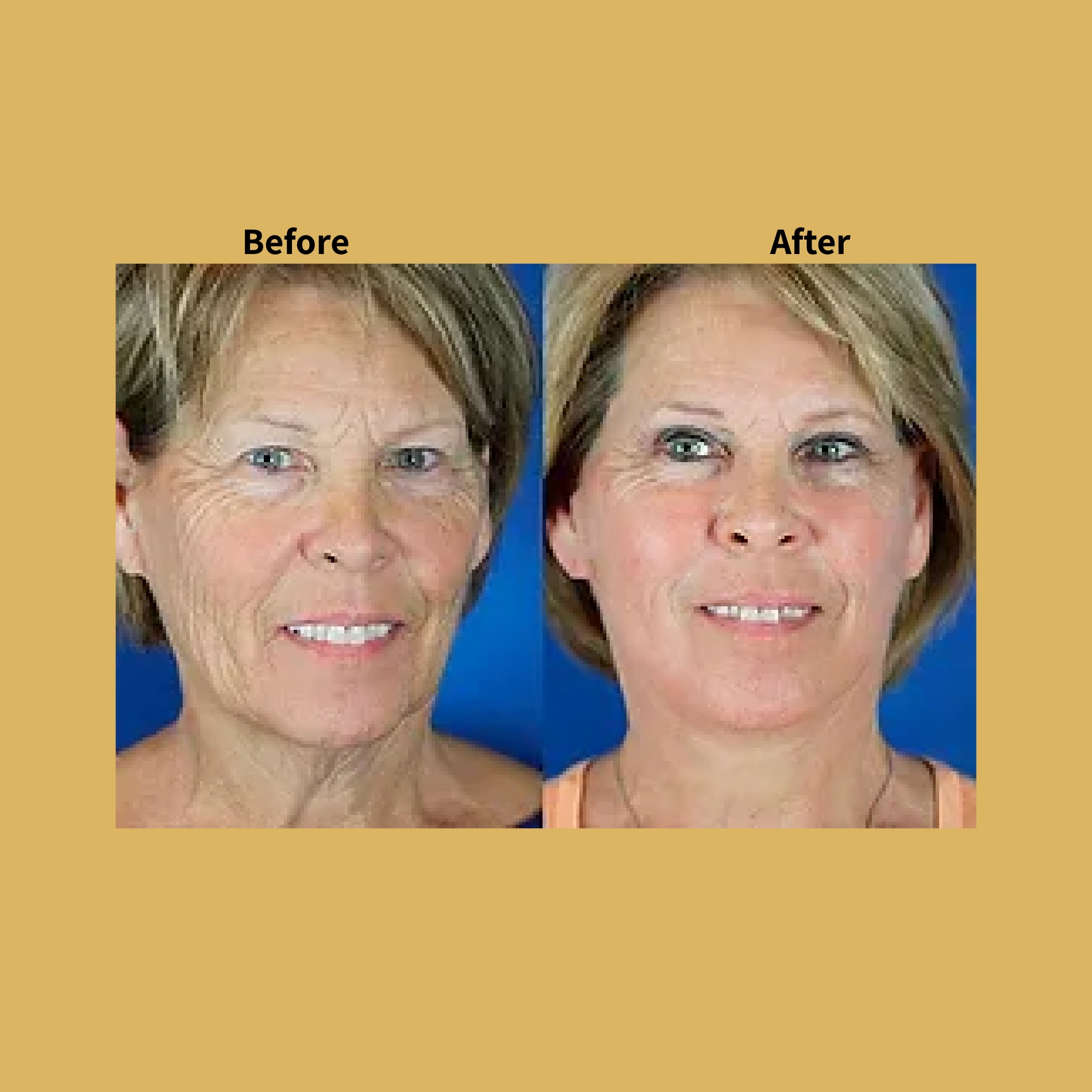Co2 Fractional Laser Treatment Before and After Photos | Soleil Medical & Beauty Spa in Portland, OR