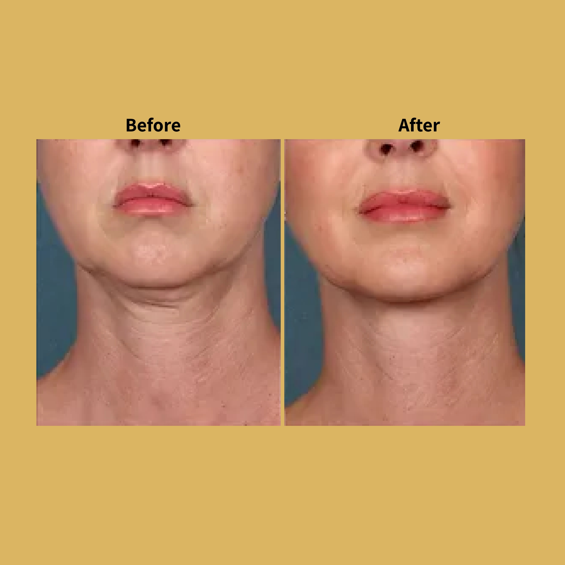 Laser Rejuvenation Before and After Treatment Photos | Soleil Medical & Beauty Spa in Portland, OR