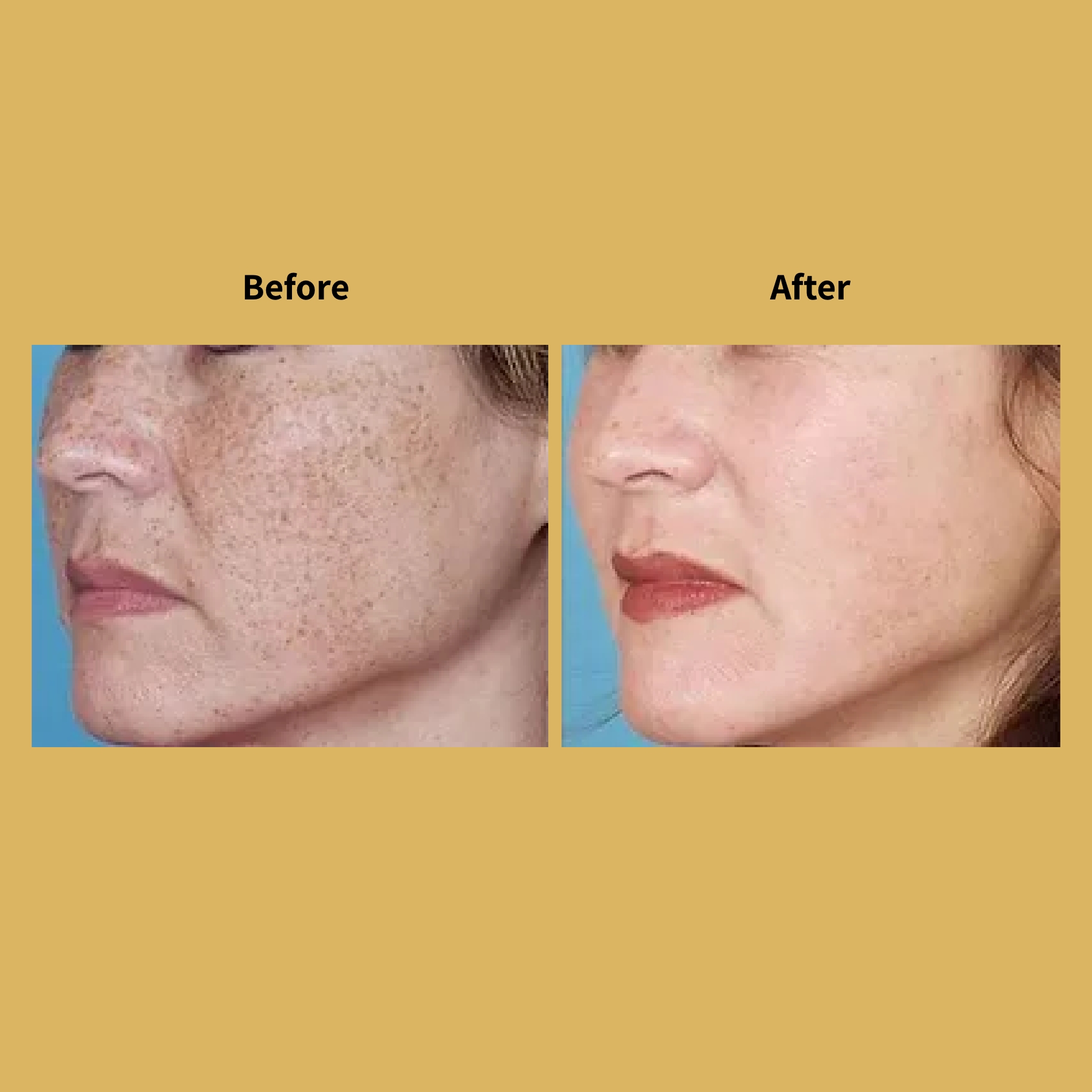 Female Laser Rejuvenation Before and After Treatment Photos | Soleil Medical & Beauty Spa in Portland, OR