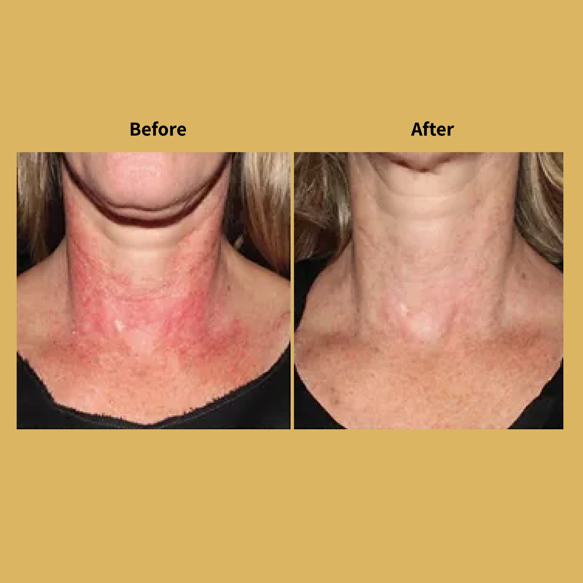 Laser Rejuvenation Before and After Treatment Photos | Soleil Medical & Beauty Spa in Portland, OR