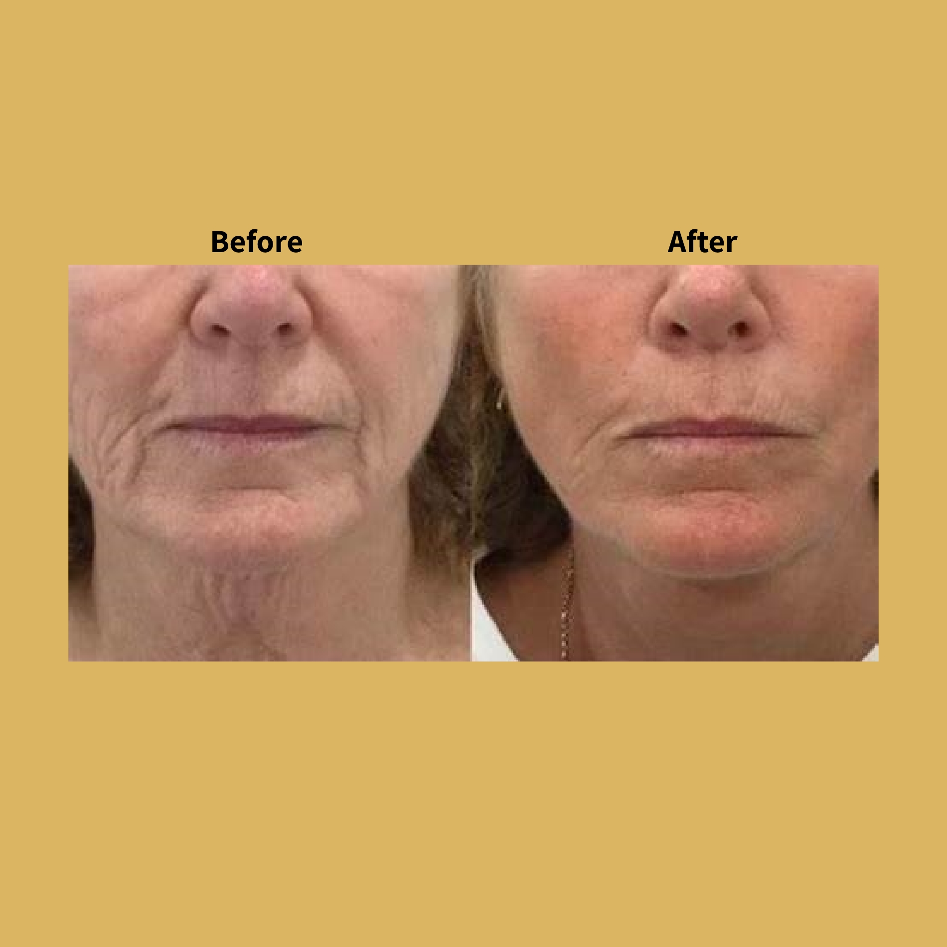 Opus Plasma Skin Tightening Before and After Treatment Photos | Soleil Medical & Beauty Spa in Portland, OR