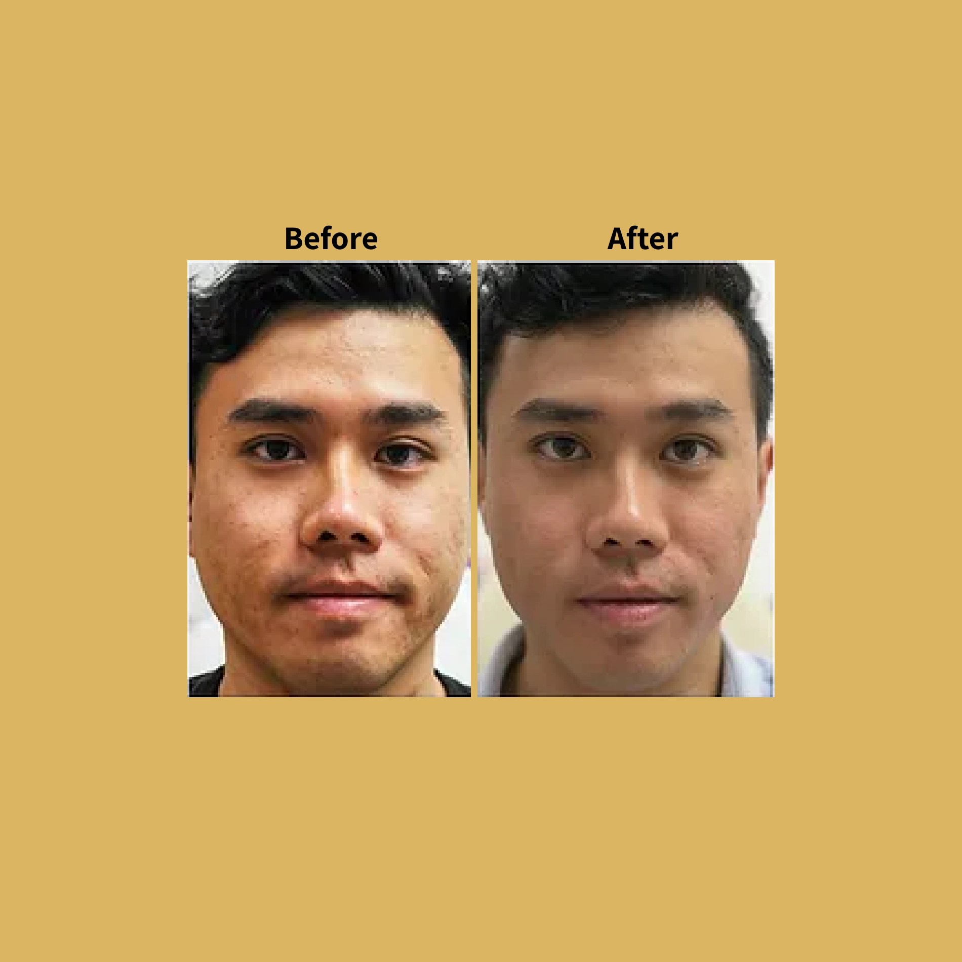 Pixel Perfect Skin Rejuvenation Before and After Photos | Soleil Medical & Beauty Spa in Portland, OR