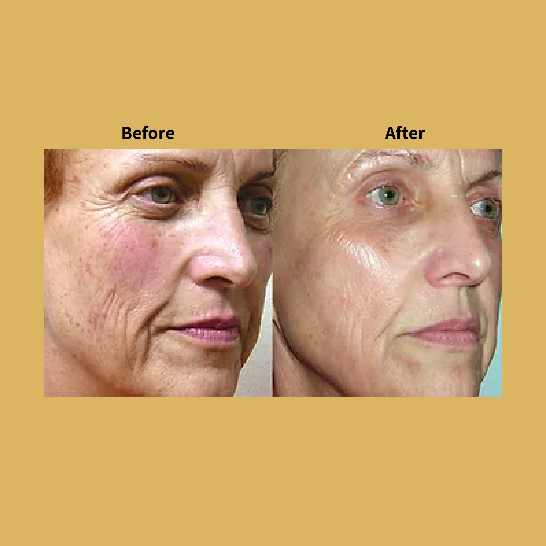 Pixel Perfect Skin Rejuvenation Treatment Before and After Photos | Soleil Medical & Beauty Spa in Portland, OR