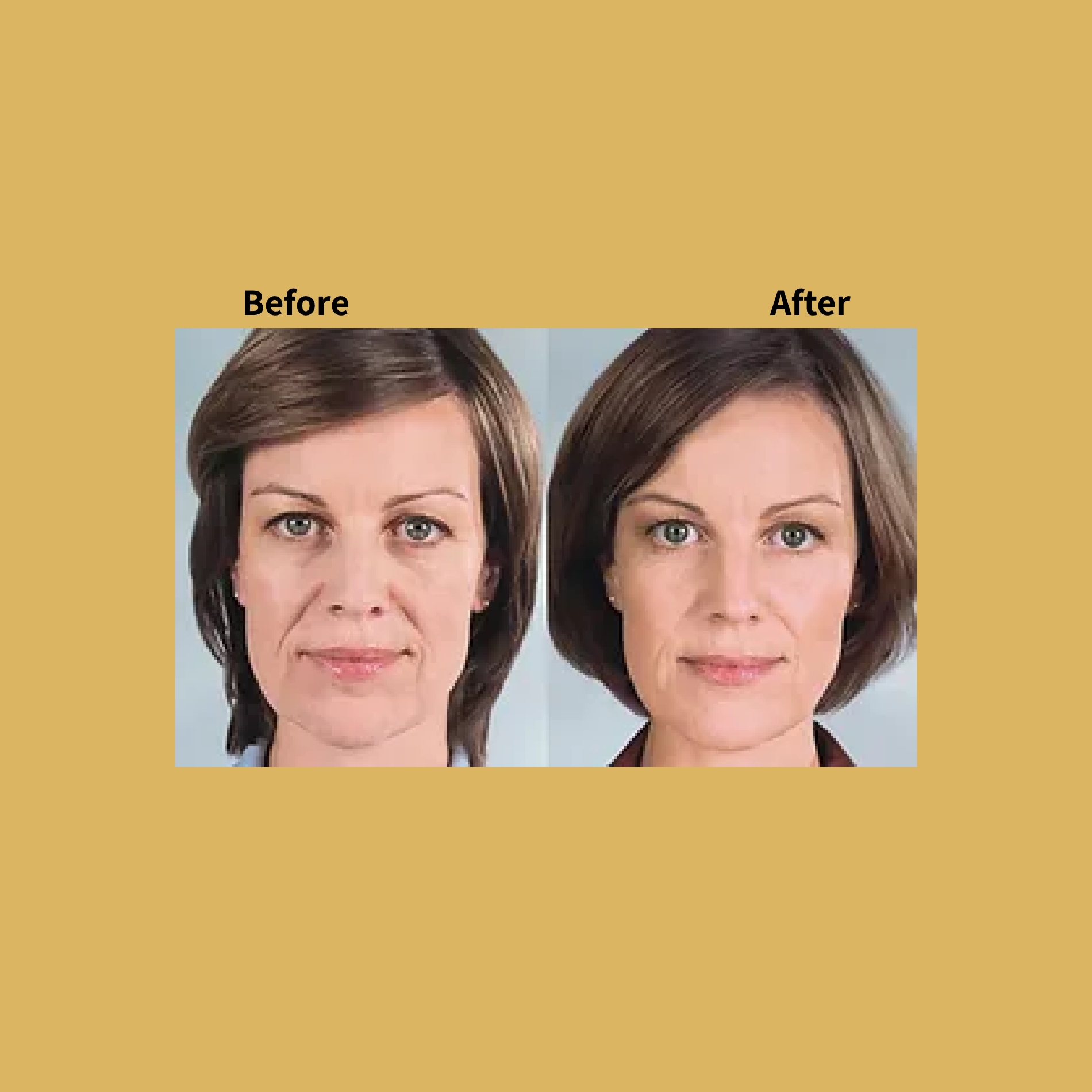 Secret RF Microneedling Treatment Before and After Photos | Soleil Medical & Beauty Spa in Portland, OR