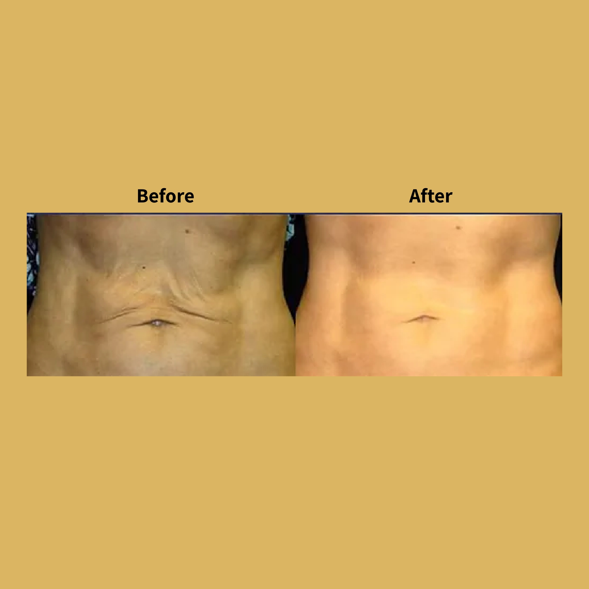 Titan Skin Tightening Treatment Before and After Photos | Soleil Medical & Beauty Spa in Portland, OR