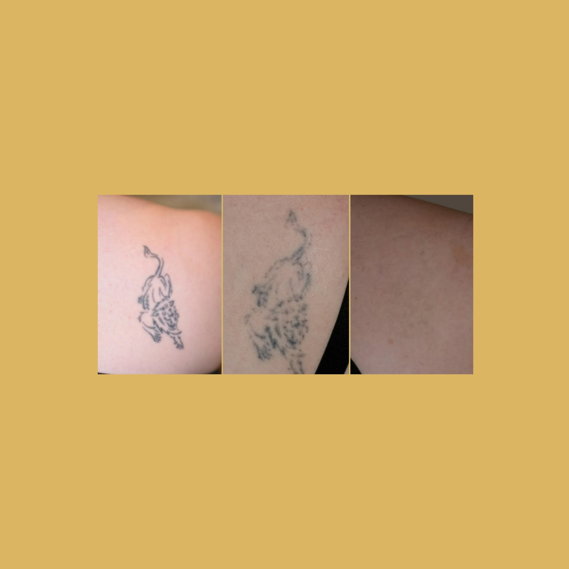 Tattoo--Before-and-After_Soleilmedicalspapdx--In-Portland-Oregon