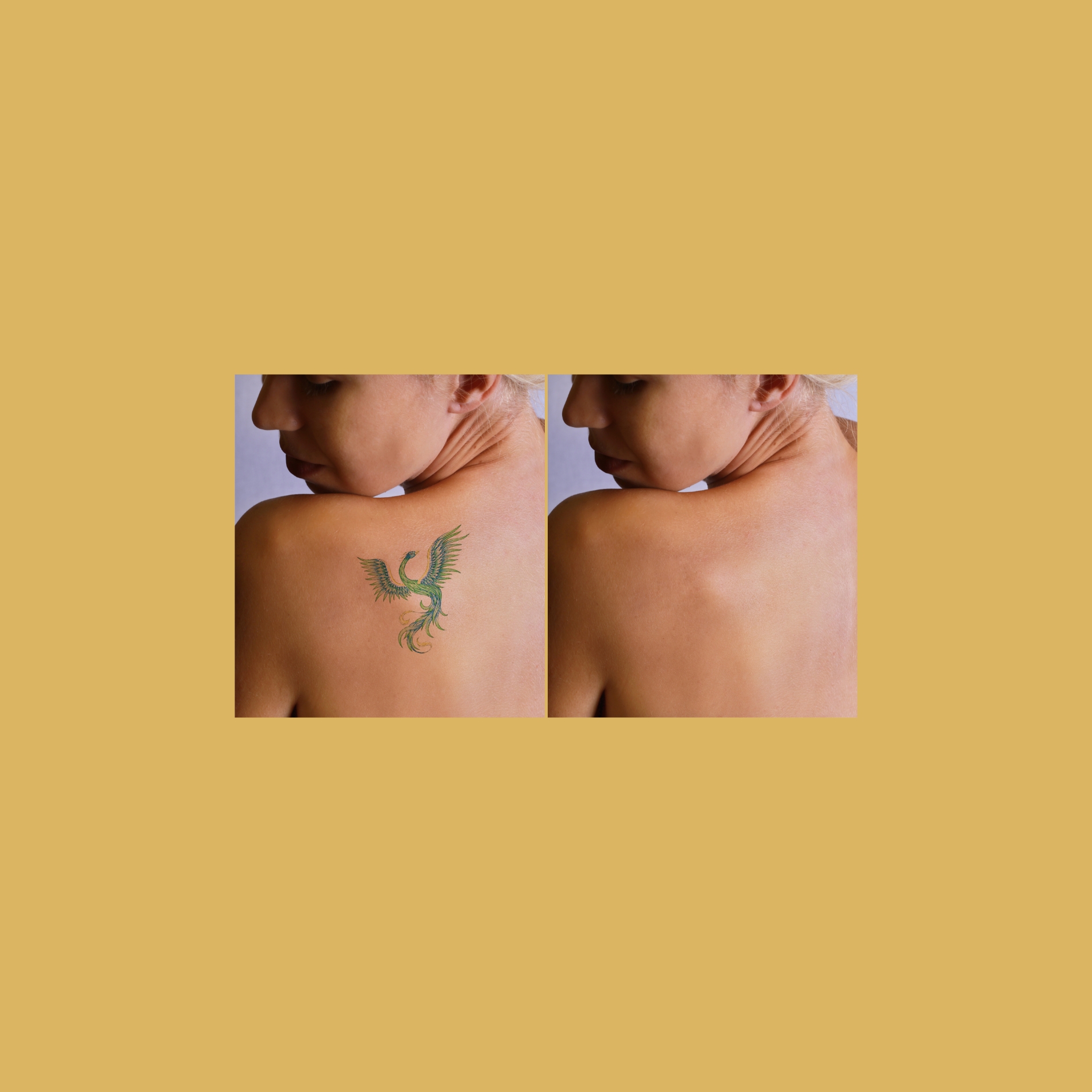 Tattoo – -Before-and-After_Soleilmedicalspapdx-_In_Portland_Oregon