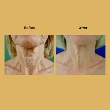 a woman's neck before and after