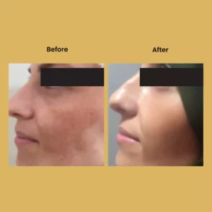 a woman's face before and after a plastic surgery