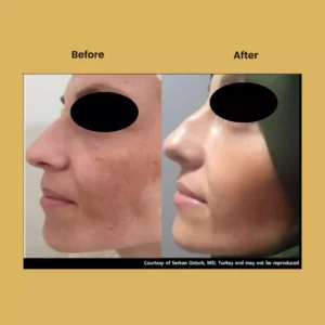 a woman's face before and after a plastic surgery