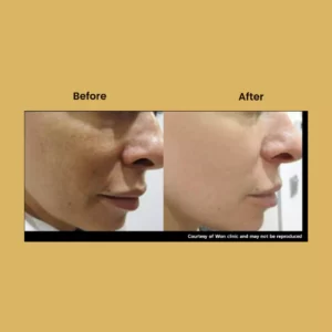a woman's face before and after a procedure