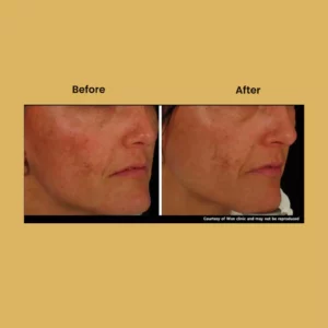 a woman's face before and after a skin treatment