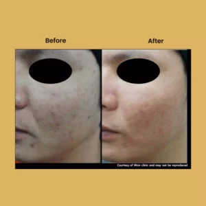 a woman's face with a black oval overlay