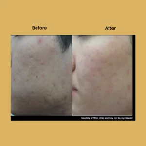 a person's face with acne