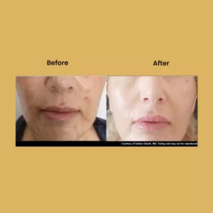 After - Before - 32
