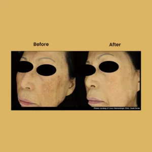 After - Before - 33
