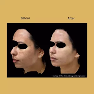 After - Before - 34