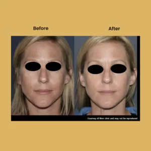 a woman before and after a plastic surgery