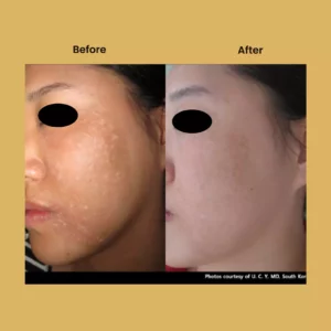 a woman's face before and after a photo