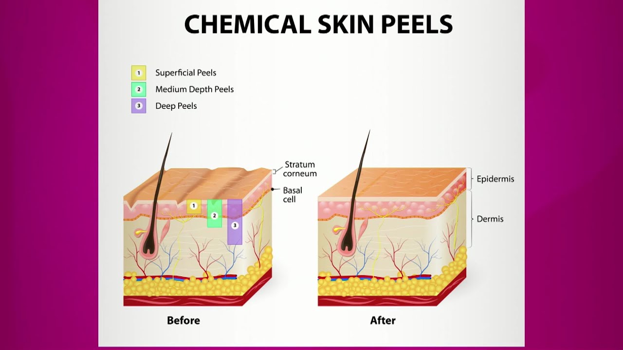 Chemical Peels in Portland, OR - Soleil Medical Spa