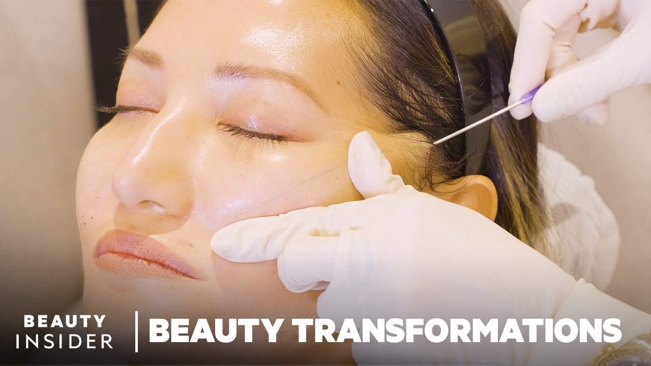 NOVA PDO Threads in Portland Non-Surgical Facelift