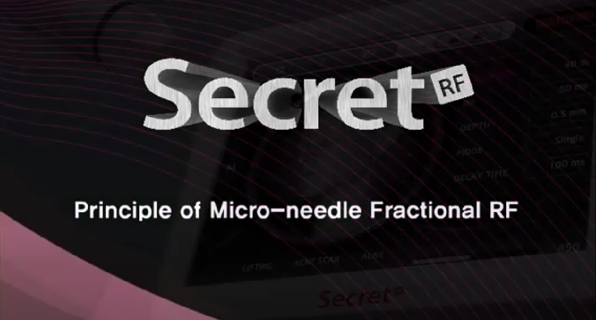 Secret RF Microneedling in Portland