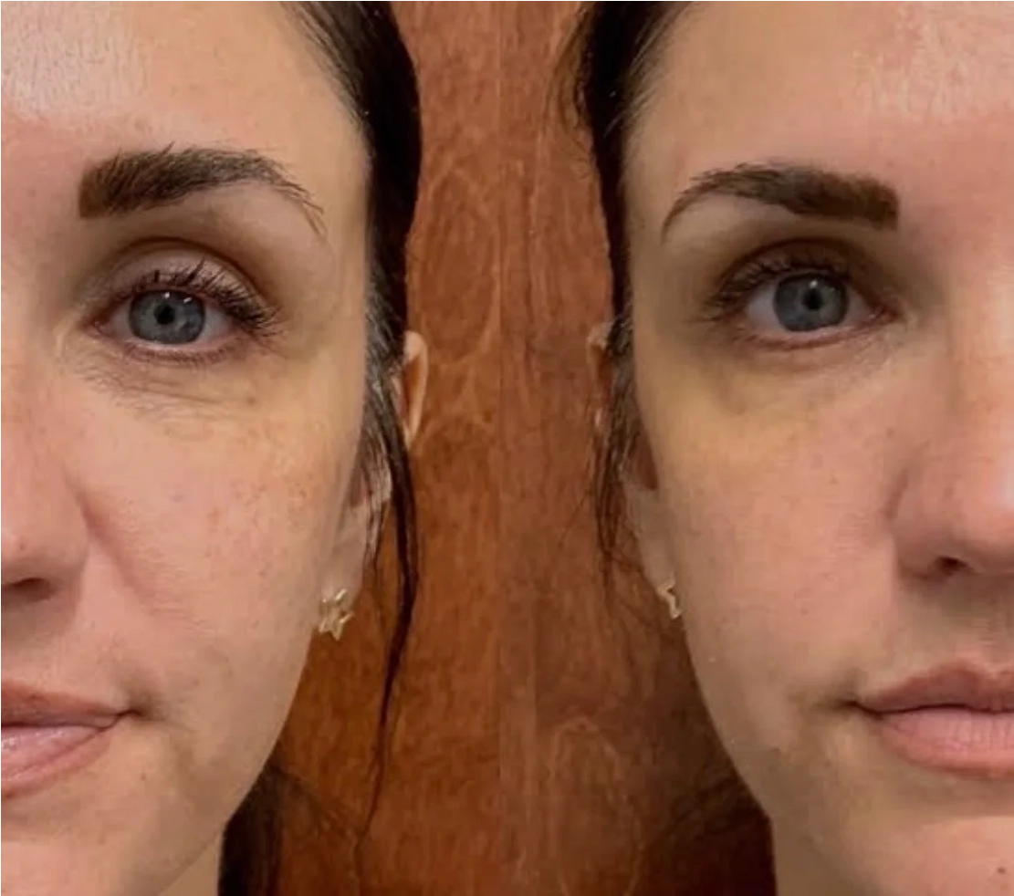 Micro Tox Before after 01