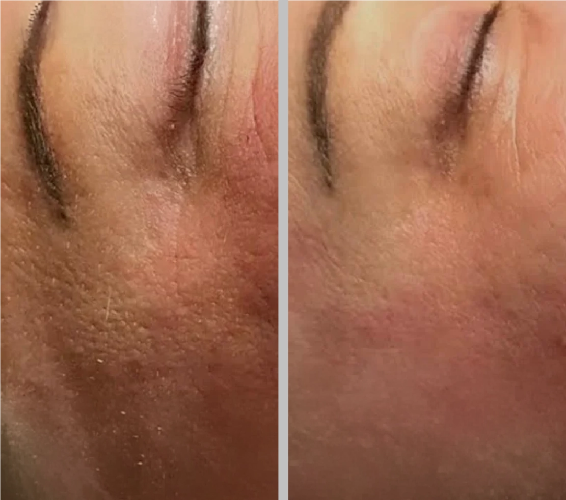 Micro Tox Before after-02