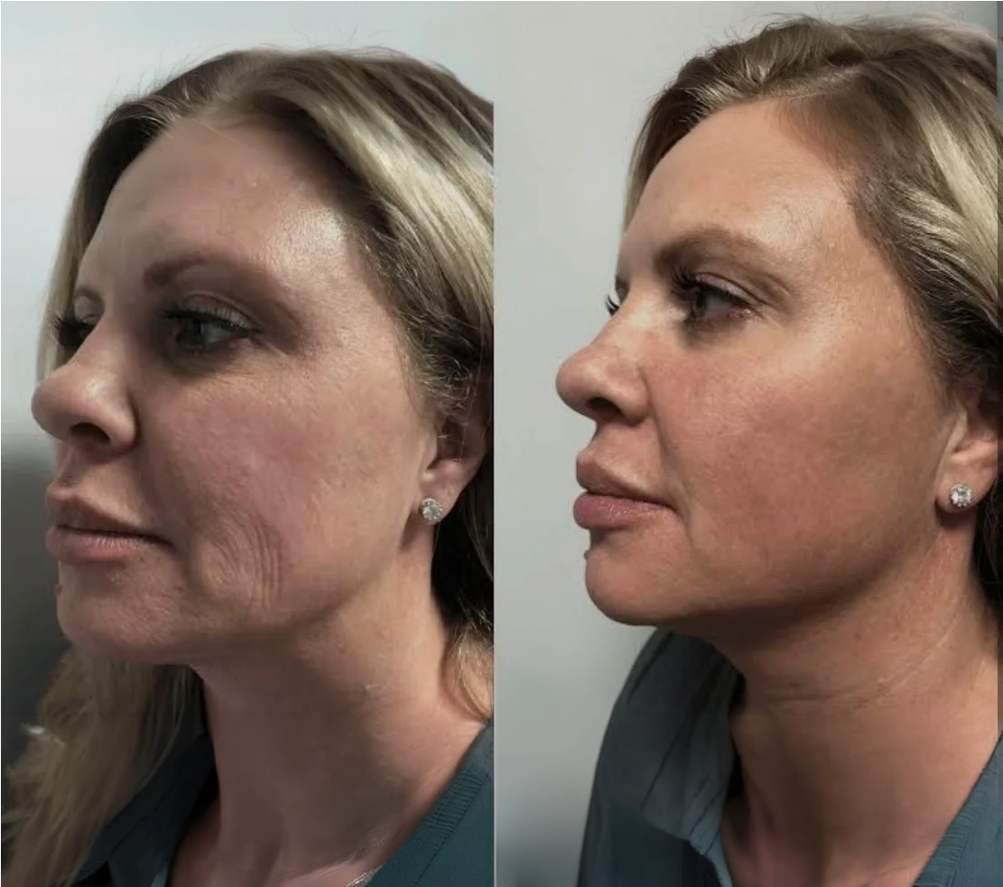 Micro Tox Before after-04