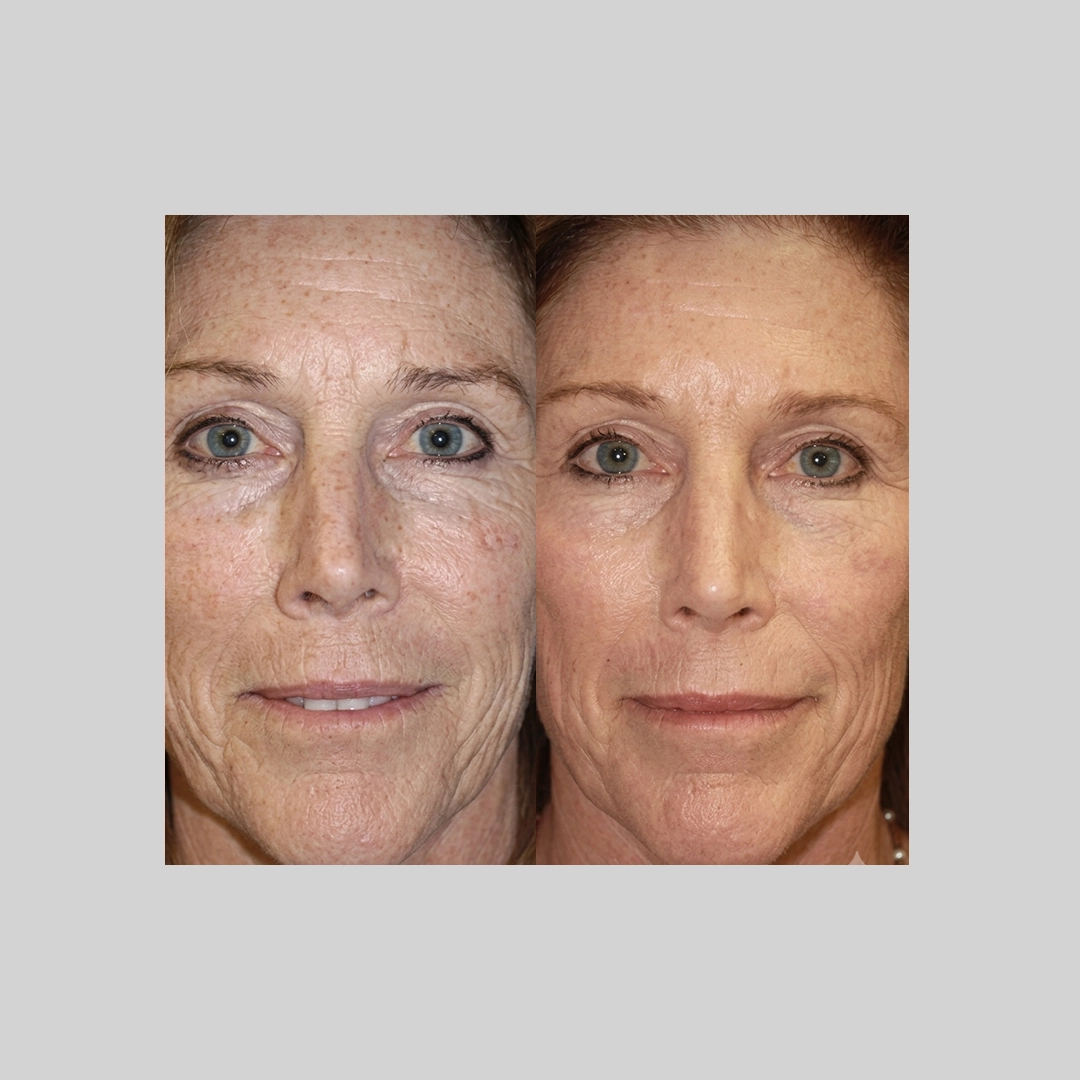 Chemical-Peels-before-after-a