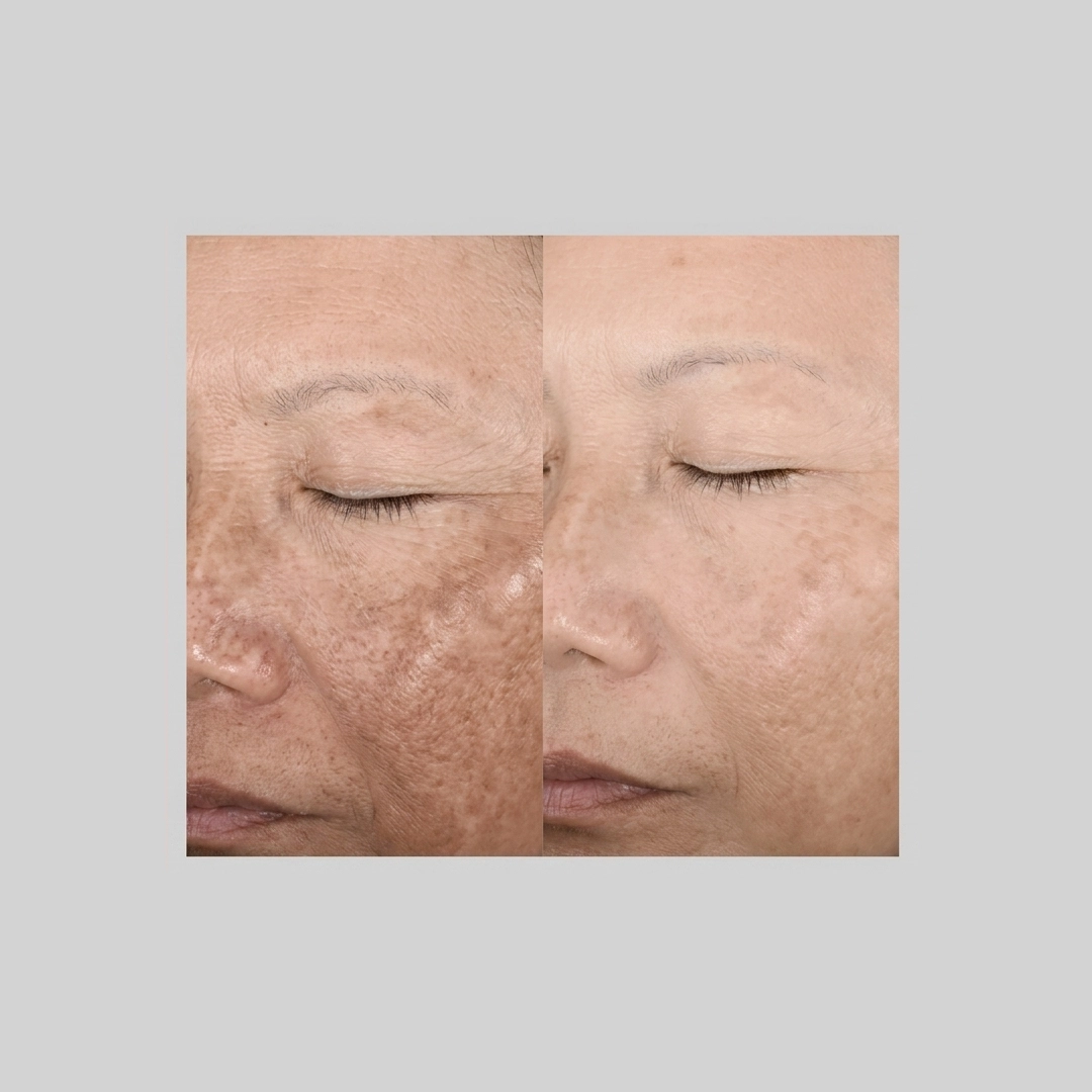 Chemical-Peels-before-after-c