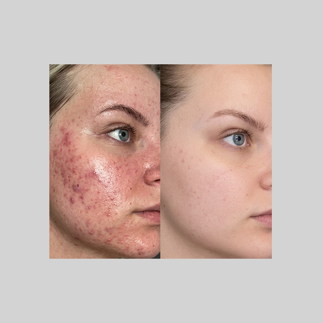 Chemical-Peels-before-after-d