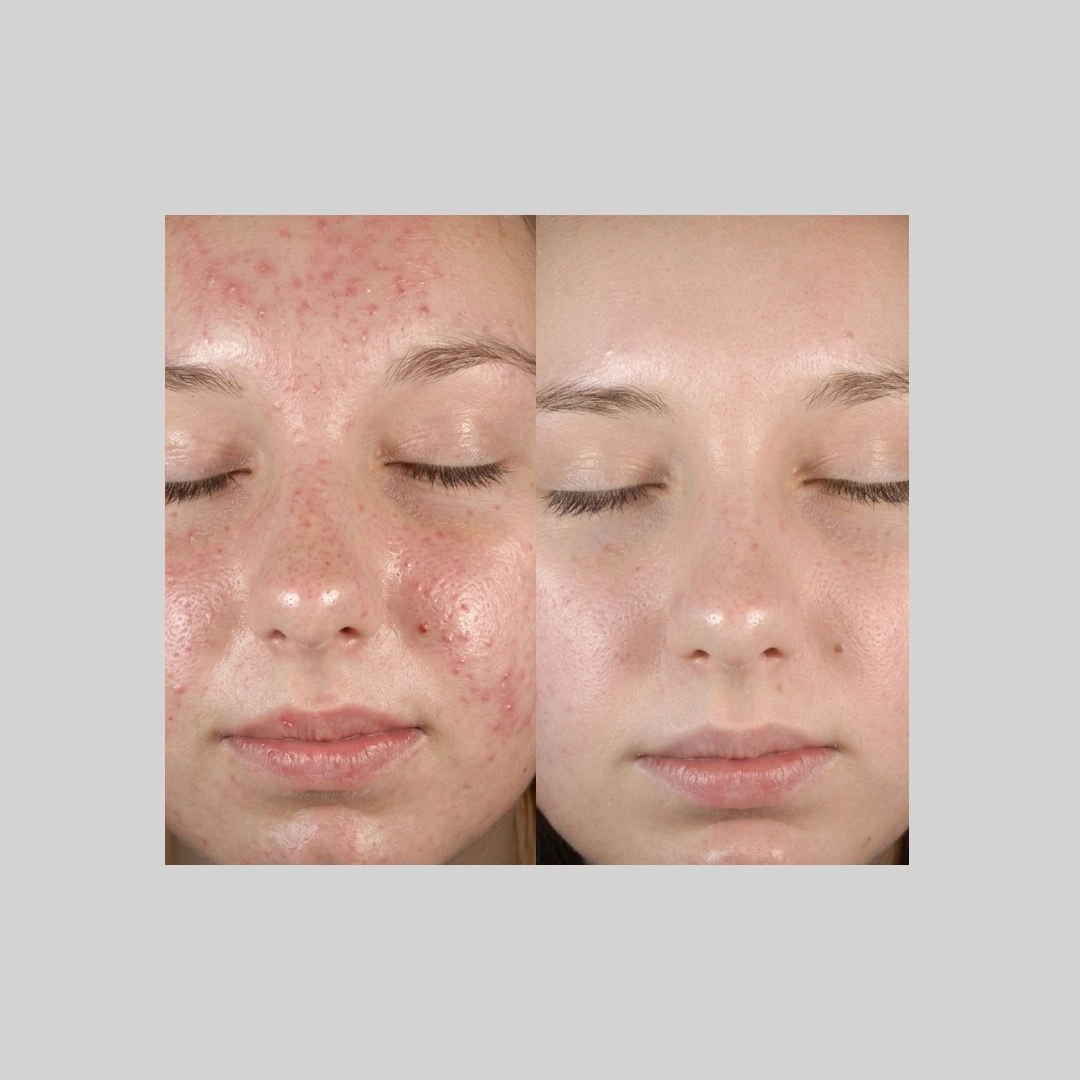 Chemical-Peels-before-after-e